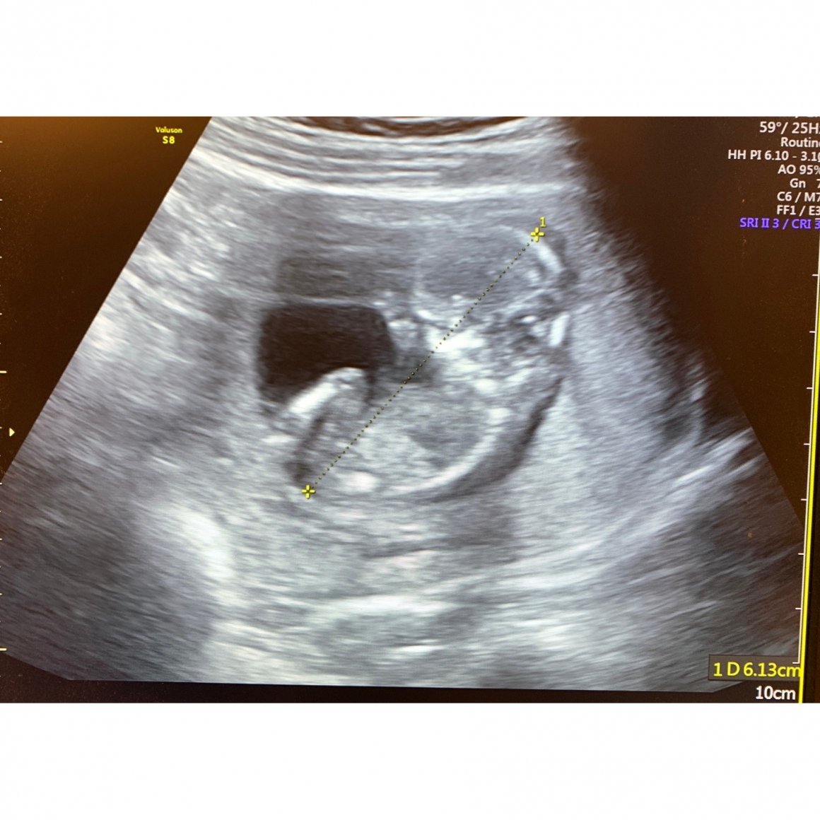 游姿寧醫師試管案例