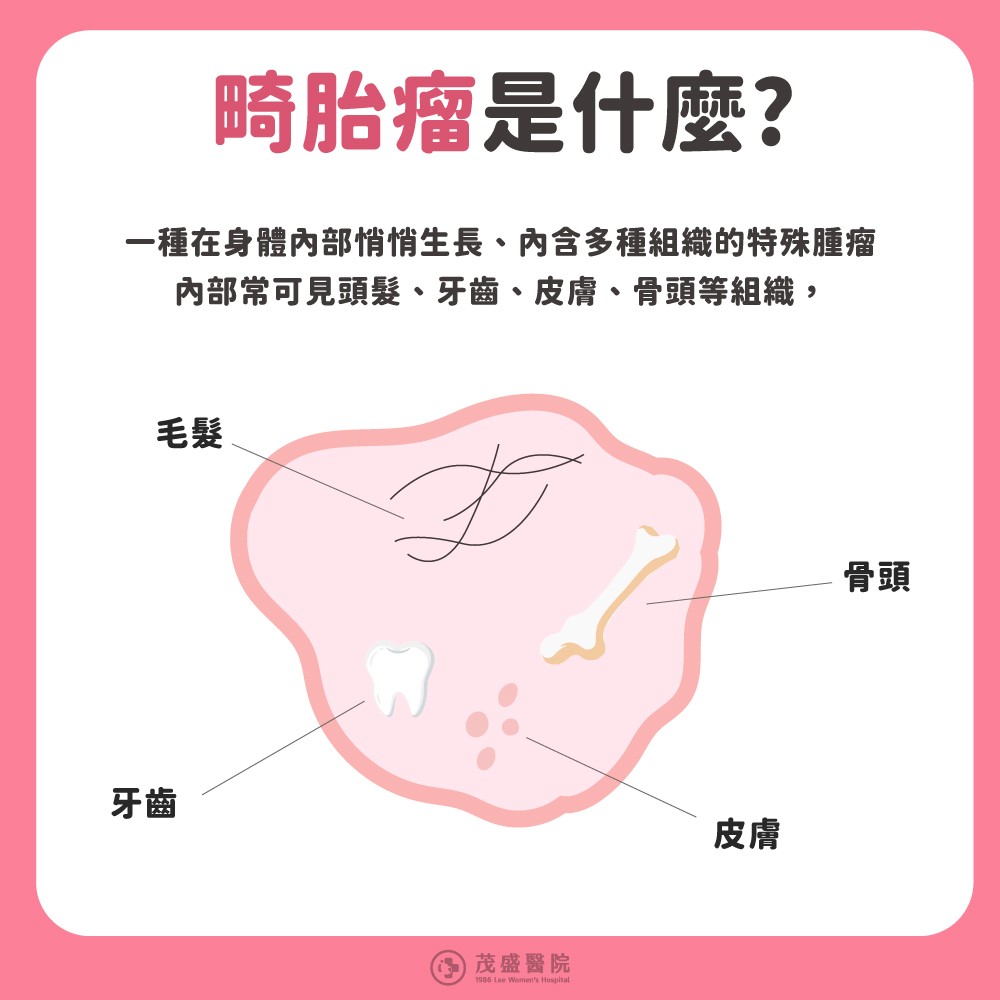 畸胎瘤是一種在身體內部悄悄生長、內含多種組織的特殊腫瘤；內部常可見頭髮、牙齒、皮膚、骨頭等組織。