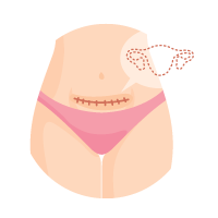 無子宮或子宮機能受損，等待代理孕母合法期間