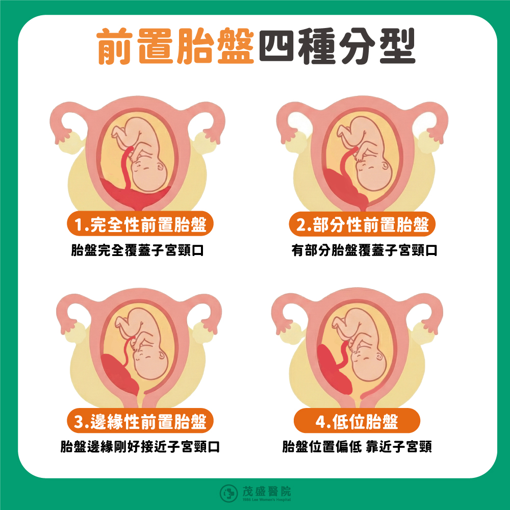 前置胎盤四種分型示意圖