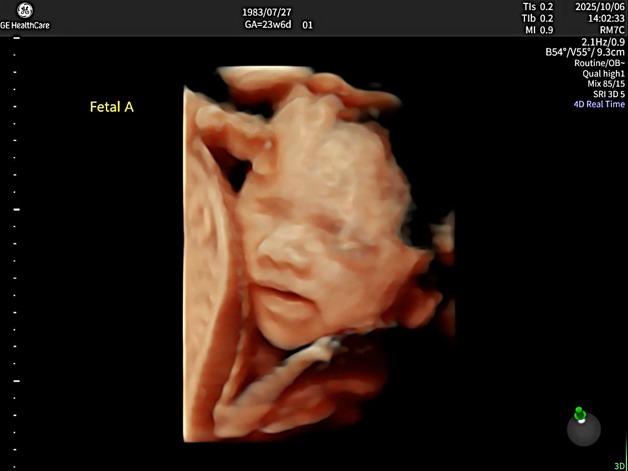 台中茂盛醫院率先引進千萬旗艦級超音波－E22