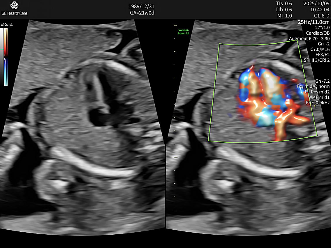 E22超音波同時搭載多項高階影像技術，例如：高解析血流顯影技術，能清楚呈現胎盤與胎兒微小血管的血流狀態，幫助醫師更精準評估胎盤功能與胎兒循環狀況。