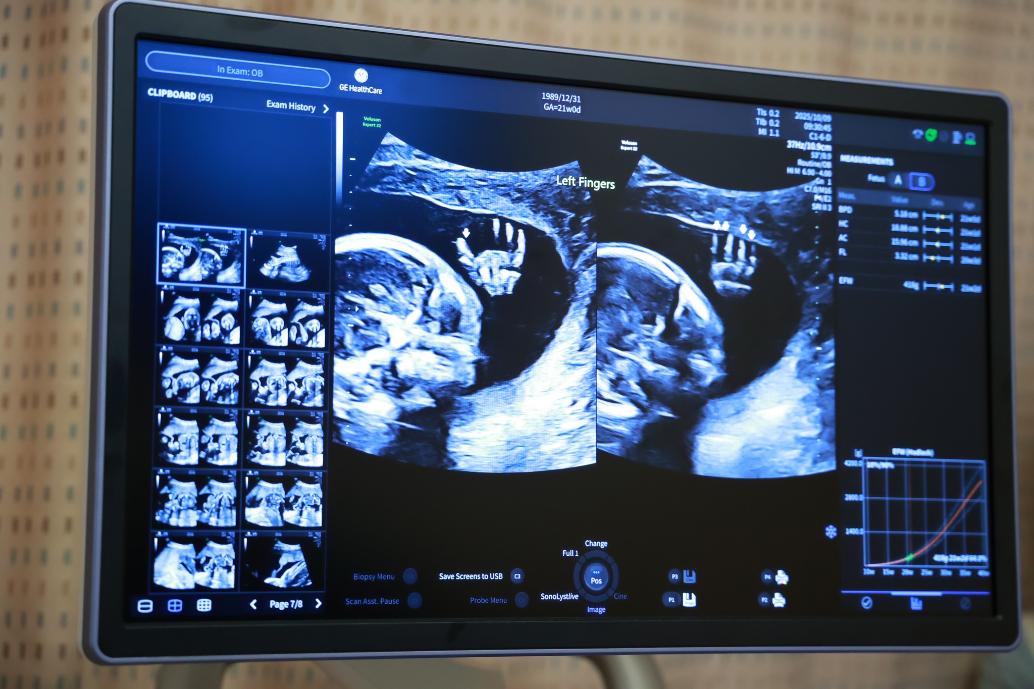 台中茂盛醫院率先引進千萬旗艦級超音波－E22