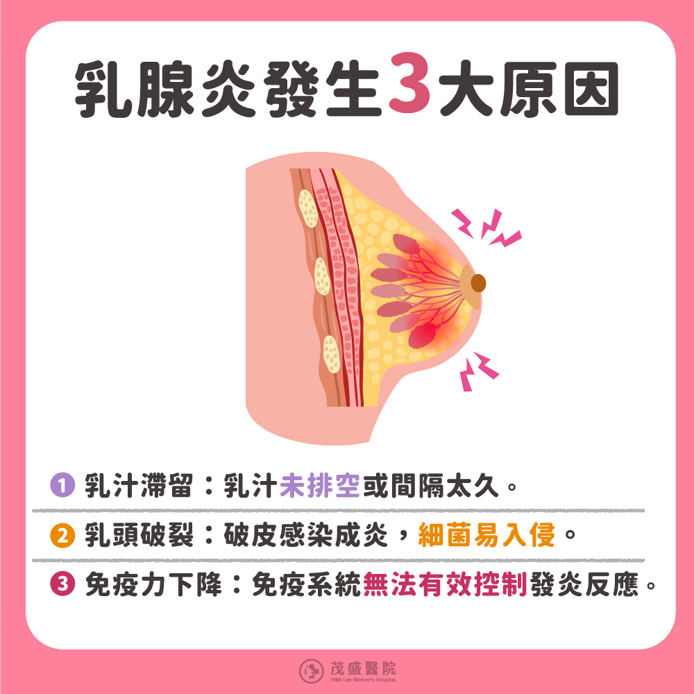 乳腺炎發生原因