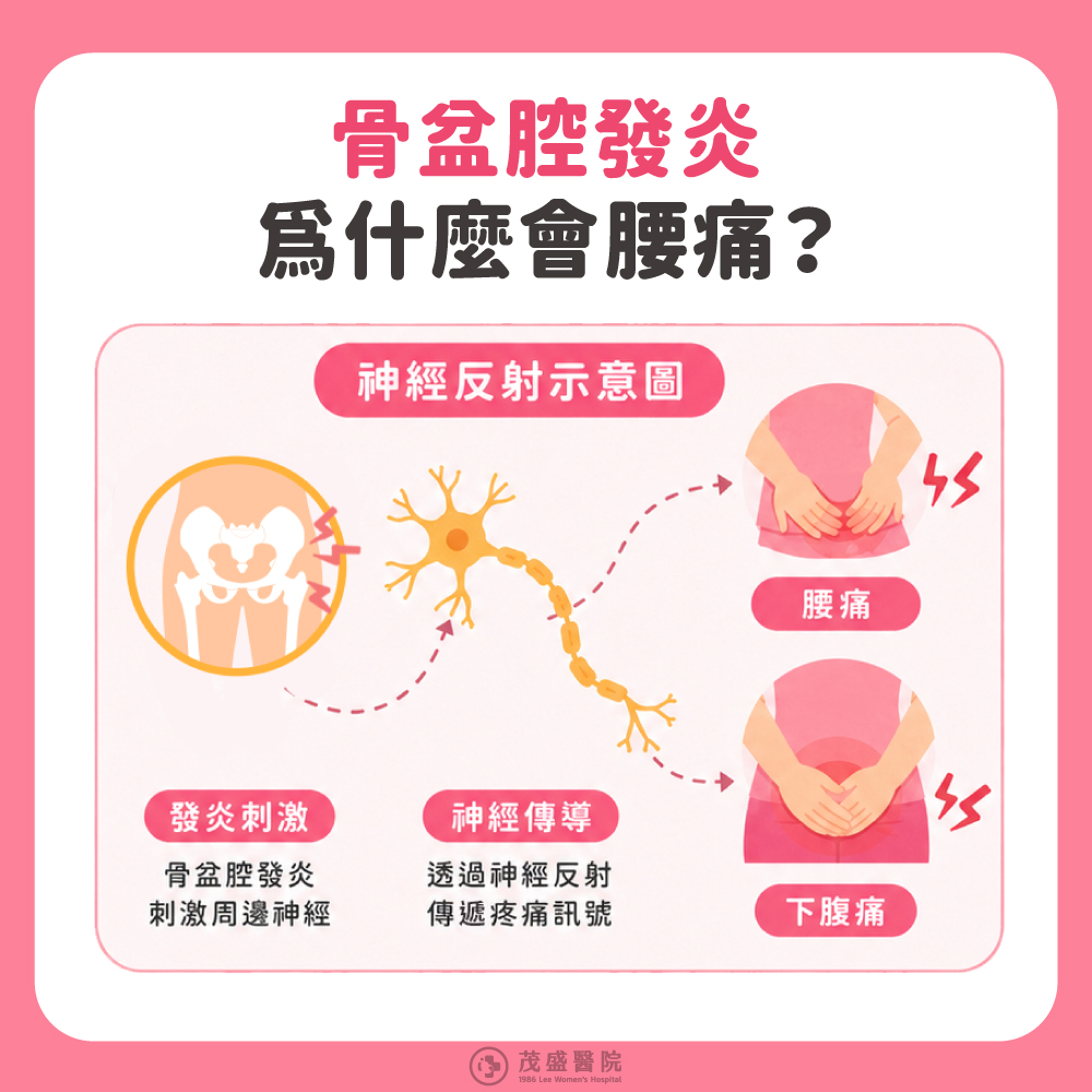 骨盆腔發炎症狀，為什麼會腰痛
