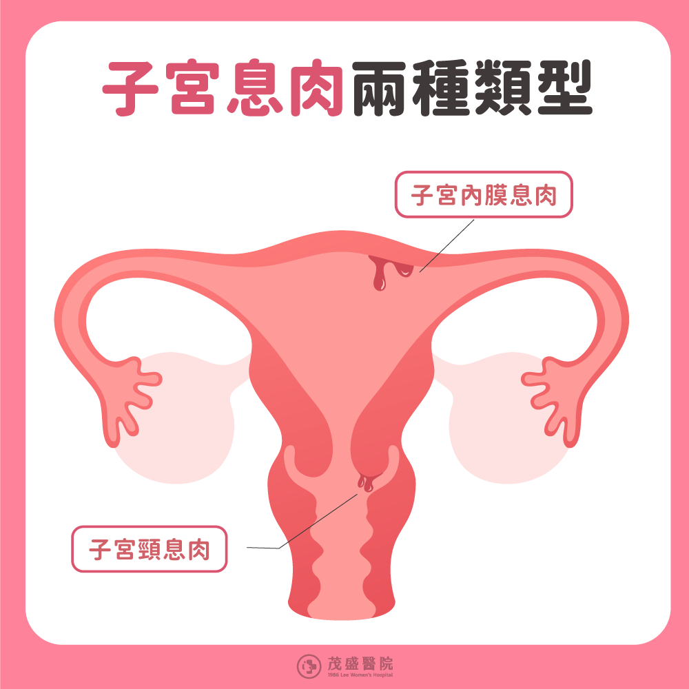 子宮內膜息肉 vs 子宮頸息肉